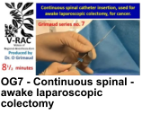 OG7 - Continuous spinal - awake laparoscopic colectomy