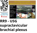 RR9 - USG supraclavicular brachial plexus
