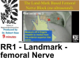 RR1 - Landmark - femoral Nerve