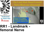 RR1 - Landmark - femoral Nerve