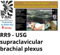 RR9 - USG supraclavicular brachial plexus